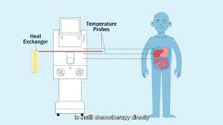 Hyperthermic intraperitoneal chemotherapy HIPEC for Pediatric Cancer [upl. by Costa515]