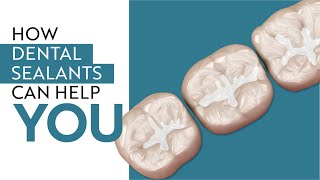 Are Dental Sealants Necessary [upl. by Routh]