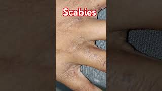 scabies skincare fungaldisease skin diseases [upl. by Ludwigg]