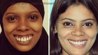 Gummy smile treated by DR ABDULLAH AL MASUD BANGLADESH [upl. by Ybhsa685]