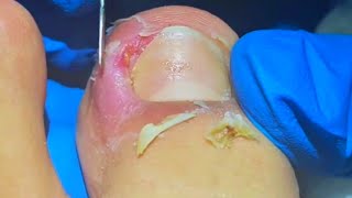 Best Techniques for Removing Seriously Infected Ingrown Toenails [upl. by Means294]