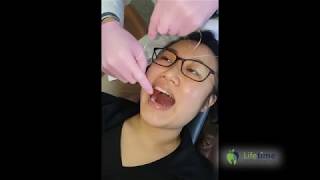 How To Replace an Orthodontic Separator [upl. by Asseret87]