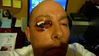 3 Days After My Eye Removal Surgery ENUCLEATION [upl. by Ruthanne]