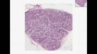 Histopathology Lymph node  Anthracosis [upl. by Adihaj]