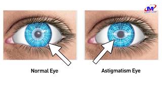 O que é Astigmatismo [upl. by Tricia]
