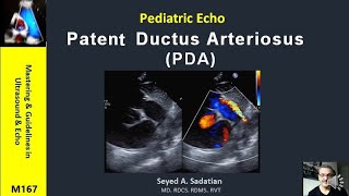 Pediatric Echo  Patent Ductus Arteriosus PDA [upl. by Daye]