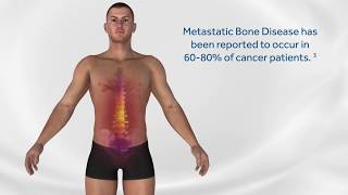 OsteoCool™ Bone RF Ablation – Minimal invasive spinal and extraspinal metastasis treatment [upl. by Redwine]