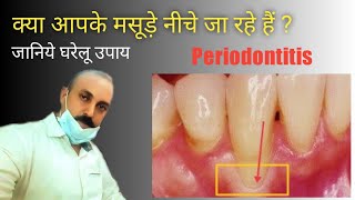 dental gumsrecession क्या आपके मसूड़े नीचे जा रहे हैं  Best home remedies for periodontitis [upl. by Salina273]