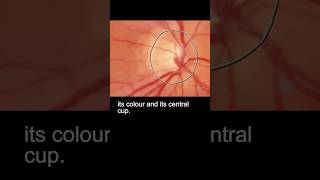 Examining the fundus – part 2 ophthalmology [upl. by As]