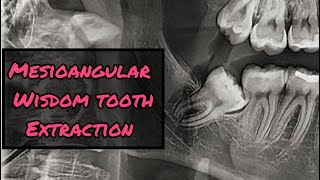 Mesioangular Wisdom Tooth Extraction StepbyStep [upl. by Vedis]