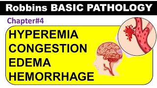 Chp4 Part1 Robbins Basic Patho  Hyperemia  Congestion  Edema  Hemorrhage  General Pathology [upl. by Ramedlaw]