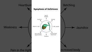 😱😳SYMPTOMS OF GALLSTONES  PORCELAIN GALLBLADDER Cholecystitismbbsneetviralshortstrending🛑📢💯 [upl. by Anaiv307]