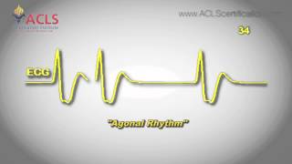 Agonal Rhythm by ACLS Certification Institute [upl. by Anelrac]