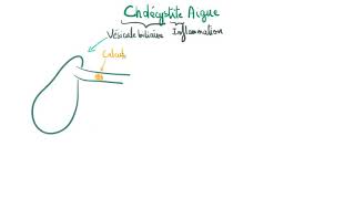 Cholécystite aiguë [upl. by Naaman209]