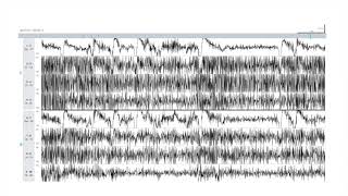 EEG Atlas B1 Recognize Common Artifacts Seen on EEG Using The Ceribell Rapid Response System [upl. by Azaria]