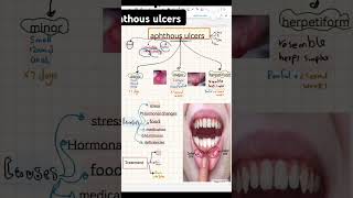 Aphthous ulcers dental dentistrydegree dentistdoctor dentistrystudent [upl. by Sulecram993]