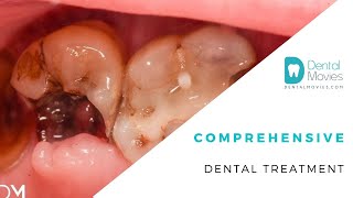 Comprehensive dental treatment [upl. by Sprague]