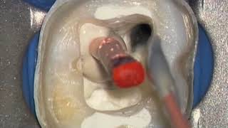 Shape Clean Pack 3D Obturation  Vertical Compaction Clinical Op Dr Ruddle Advanced Endodontics [upl. by Ellecrag592]