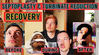 NOSE JOB My Septoplasty amp Turbinate Reduction Surgery Day By Day Recovery [upl. by Attoynek]