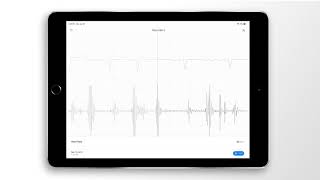 Atrial Fibrillation Combined Heart Sound PCG amp ECG Example  EkoCLINIC App [upl. by Onihc389]