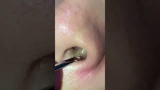 Nose Pimple Popping pimple blackhead [upl. by Renny]