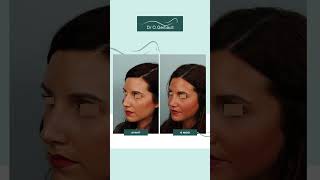 Rhinoplastie ultrasonique pour bosse et nez devié [upl. by Atis]