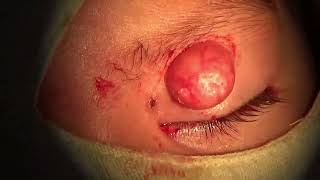 Molluscum Contagiosum Lesions Excision [upl. by Medeah]