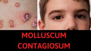 What is Molluscum Contagiosum Symptoms Treatment [upl. by Danieu]