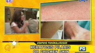 Keratosis Pilaris or Chicken Skin [upl. by Ayhdnas]