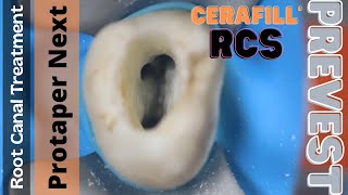 Root Canal Treatment in Maxillary Molar ⚪️ Protaper Next 🔵 Cerafill RCS Obturation [upl. by Seibold]