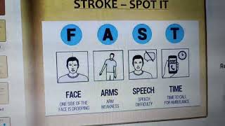 cerebrovascular accident [upl. by Cyndia]