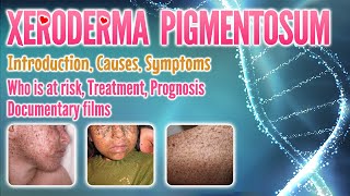 Xeroderma pigmentosum causes symptoms treatment prognosis documentary pronunciation  XP [upl. by Ogden177]