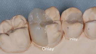 Restaurações em Resina Composta Indireta [upl. by Ardnuassak]