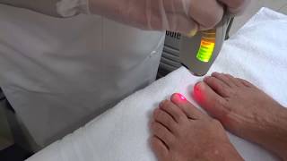 Micose de Unha  Tratamento com laser [upl. by Erroll]