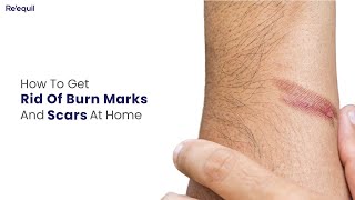 How To Get Rid Of Burn Marks And Scars At Home [upl. by Alleyn]