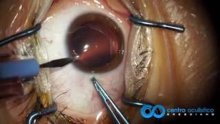 Phakic IOL  ICL Staar Visian Implantation Technique [upl. by Adnarahs]