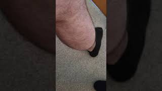 benign fasciculation syndrome  calf muscles [upl. by Georgetta140]