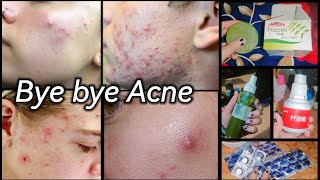 Acne treatment  Pimple Removel  Acne  Acne Removal acne pimple removeacne removepimples [upl. by Otrebtuc413]