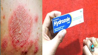 Hydrozole Cream Benefits And Uses Stop Skin itching Fungl  Khooni Kharish By Sanam [upl. by Ebeneser547]