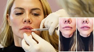 Natural Lip Injection Experience and Botox from Doctor Cynthia Cote [upl. by Marquez262]