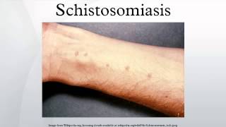 Schistosomiasis [upl. by Heman]