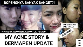 MY ACNE STORY amp DERMAPEN UPDATE  Cara aku hilangkan jerawat beruntusan bopeng  rekomendasi produk [upl. by Wasserman]