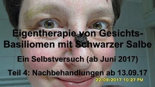 Eigentherapie von Gesichtsbasaliomen mit Schwarzer Salbe Beginn Juni 2017 Dokumentation Teil 46 [upl. by Kerk]