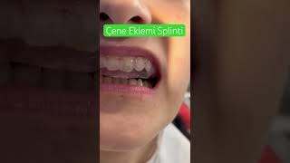 Çene Eklemi Splinti TMJ Splint [upl. by Placeeda]