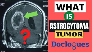 What is Astrocytoma Tumor [upl. by Brodie283]