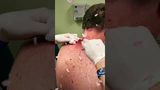 Las Vegas Dermatology Cyst Follow up video 🎥 with incision and drainage procedure 💉 🔪 [upl. by Esya]