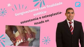 Gengivectomia com finalidade estética osteotomia e osteoplastiaHnads on dralexguedes [upl. by Aloke]