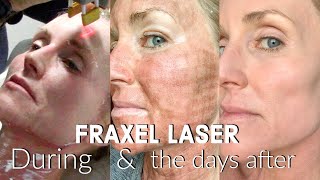 My FRACTIONAL CO2 LASER Experience  The FULL Treatment amp the DAYS following  BEFORE amp AFTER Fraxel [upl. by Rozelle]