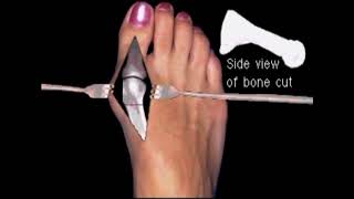 Austin bunionectomy with Akin osteotomy Moderate bunion correction surgery [upl. by Manny952]