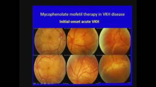 Mycophenolate mofetil therapy in VogtkoyanagiHarada disease [upl. by Perusse801]